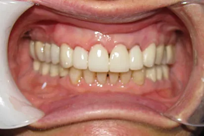 After: All porcelain anterior crowns