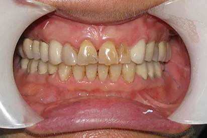 Before: All porcelain anterior crowns