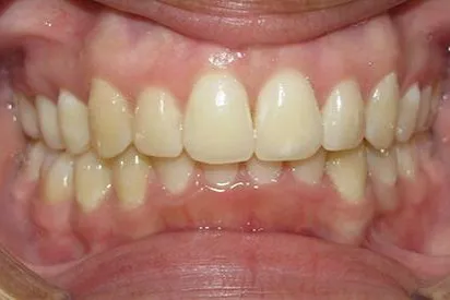 After: Invisalign
