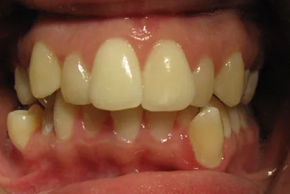 Before: Invisalign