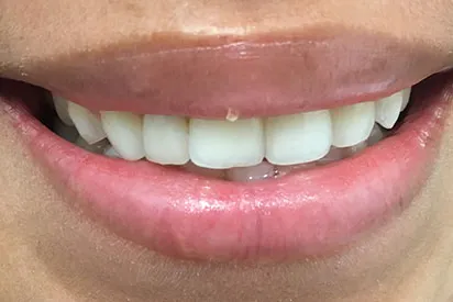 After: Invisalign