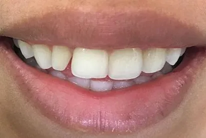 Before: Invisalign