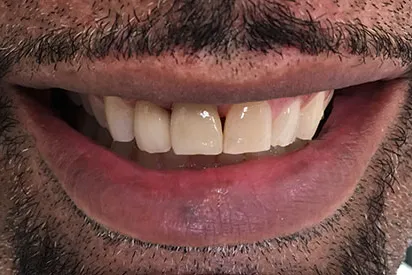After: Anterior implant & implant crown