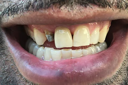 Before: Anterior implant & implant crown