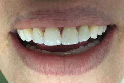 After: Anterior bonding