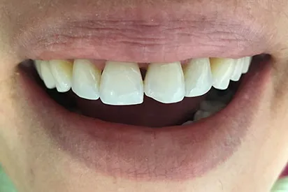 Before: Anterior bonding