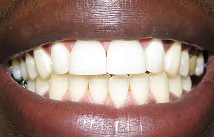 after dental treatment
