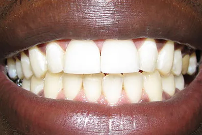 After: Anterior veneers