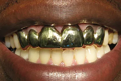 Before: Anterior veneers