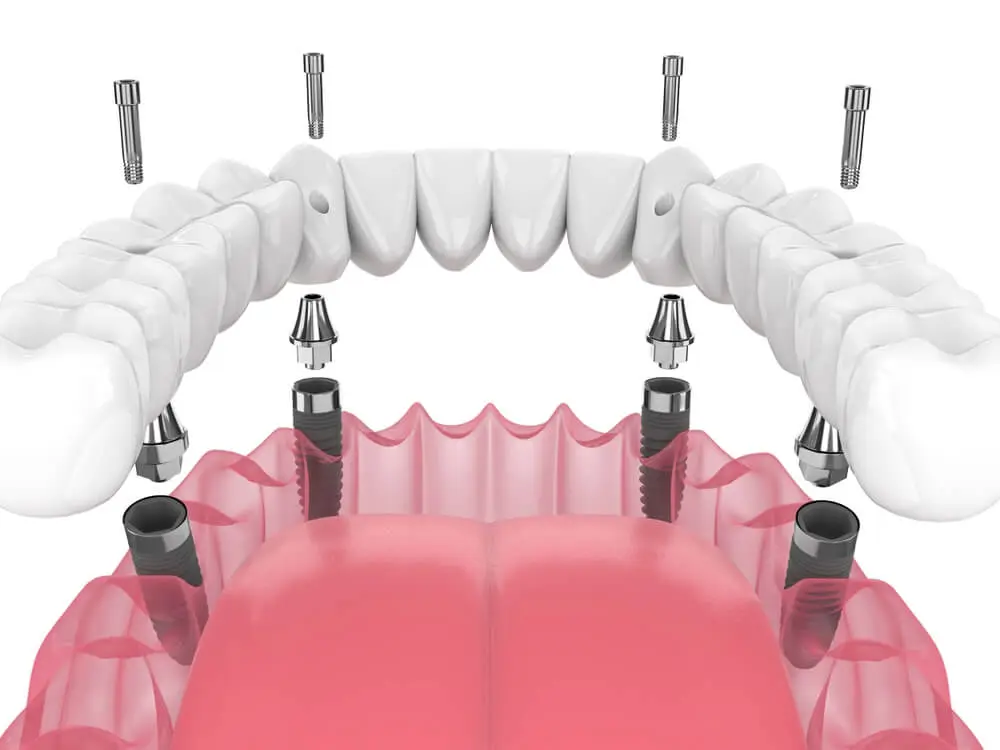 all-on-4 dental implants model