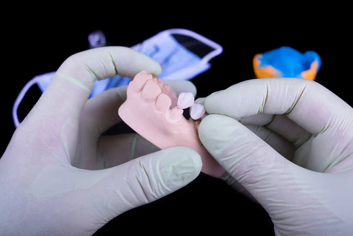 Fixed dental bridge at Dental Care Group Aventura office