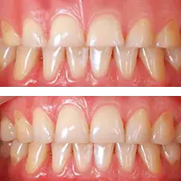 gummy smiles