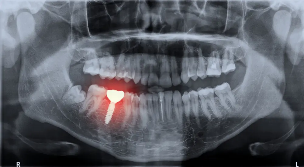 dental implant emergency x-ray image