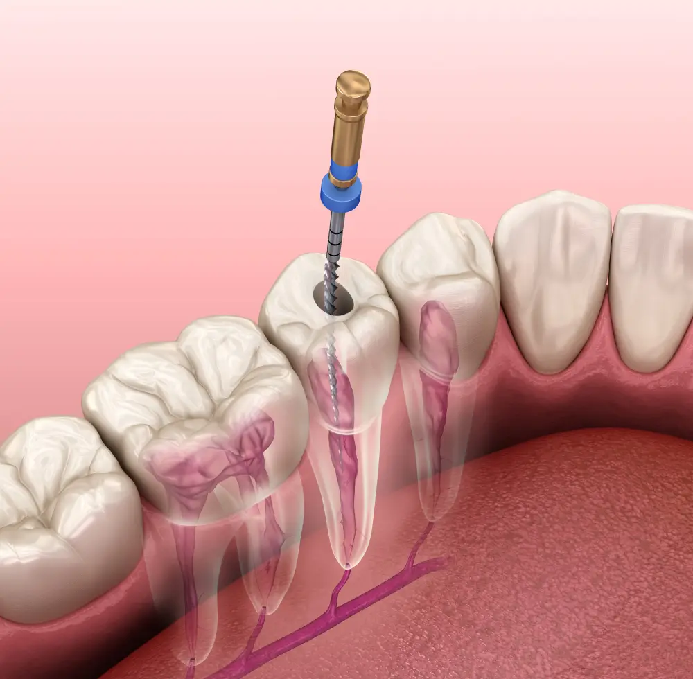 root canal treatment near you