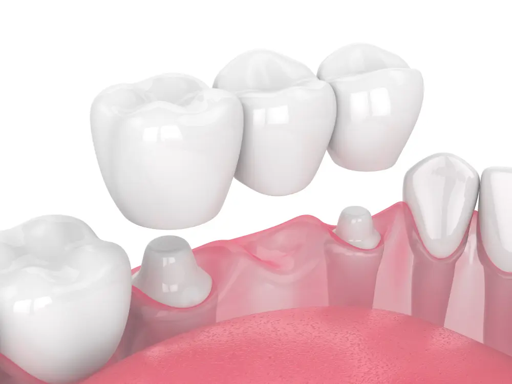 dental bridge