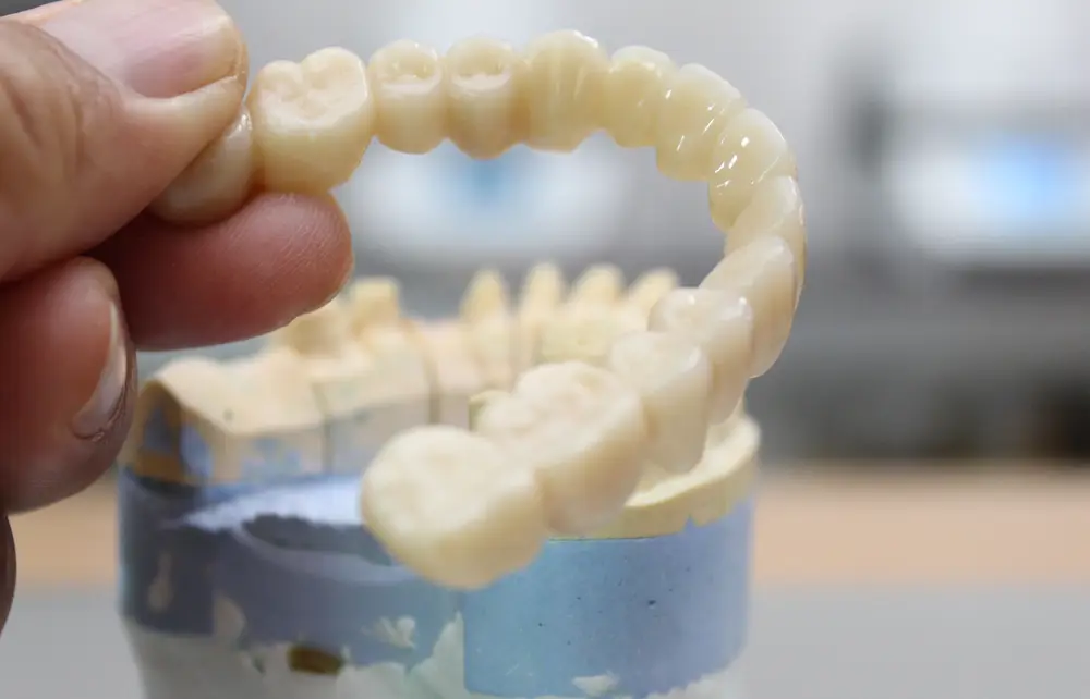 dental bridge