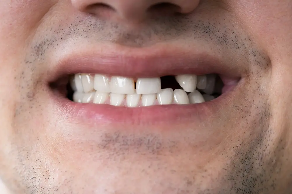 tooth loss