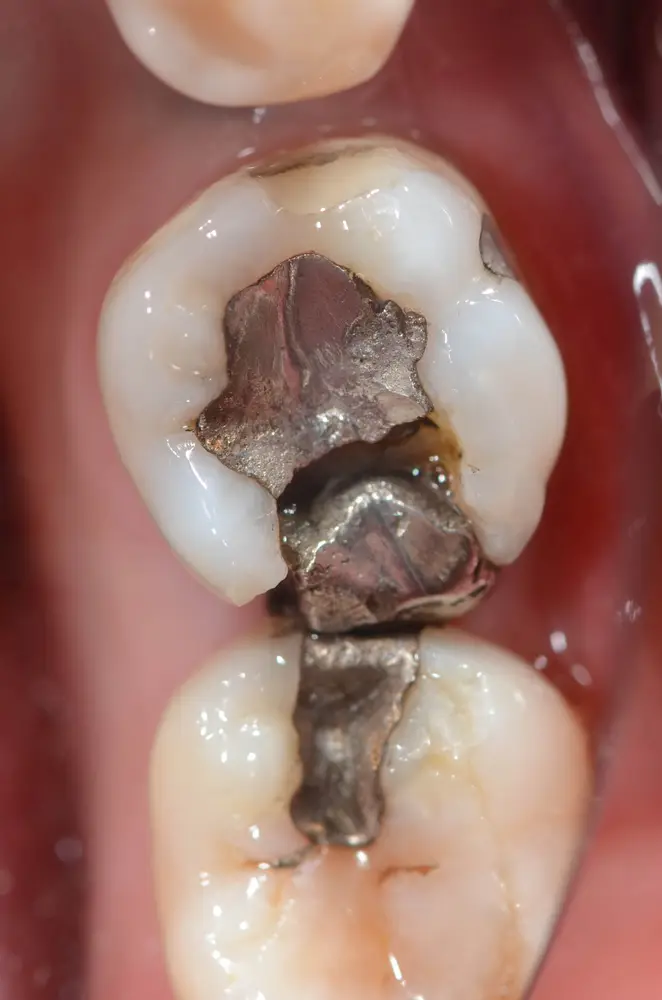 broken silver amalgam fillings 