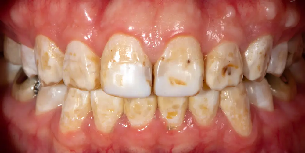 fluorosis