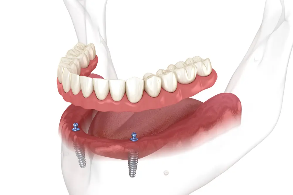 dental implant-supported denture