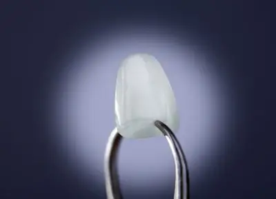 close up of ultra thin tooth lumineer