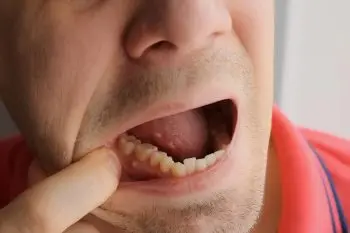 Man pulling down his lip to show a damaged lower tooth