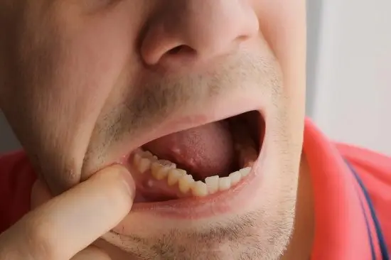 Man pulling down his lip to show a damaged lower tooth