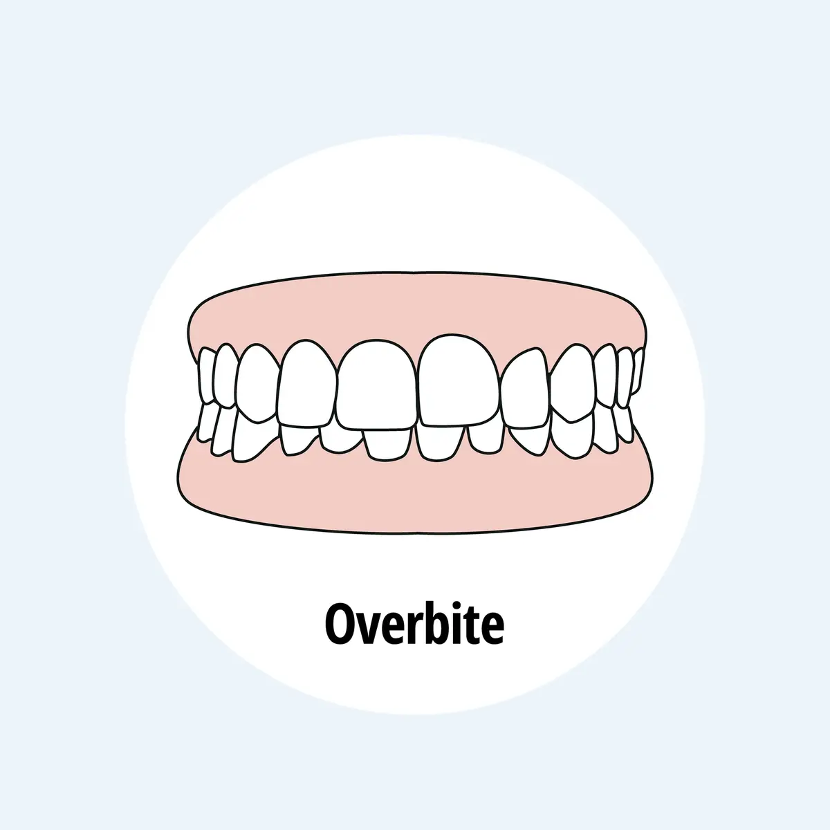 overbite