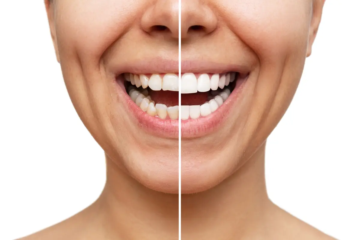 cosmetic dentistry before and after