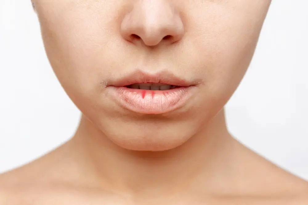 dry mouth