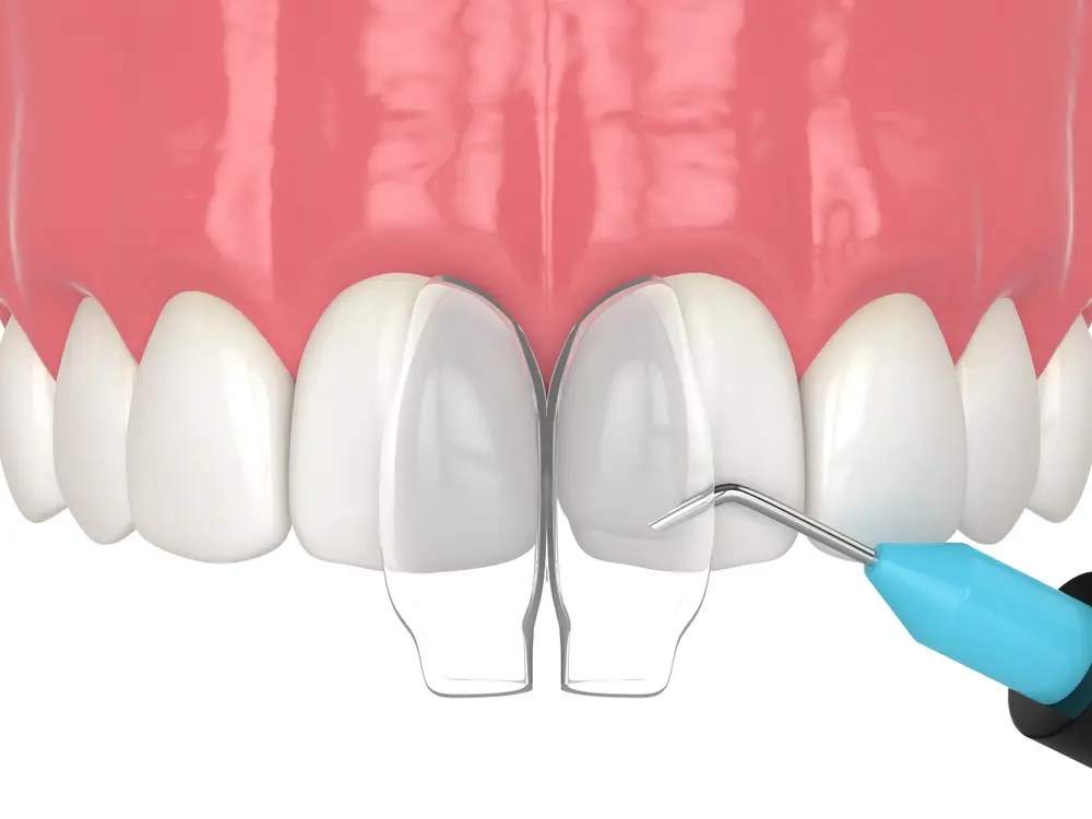 dental bonding application