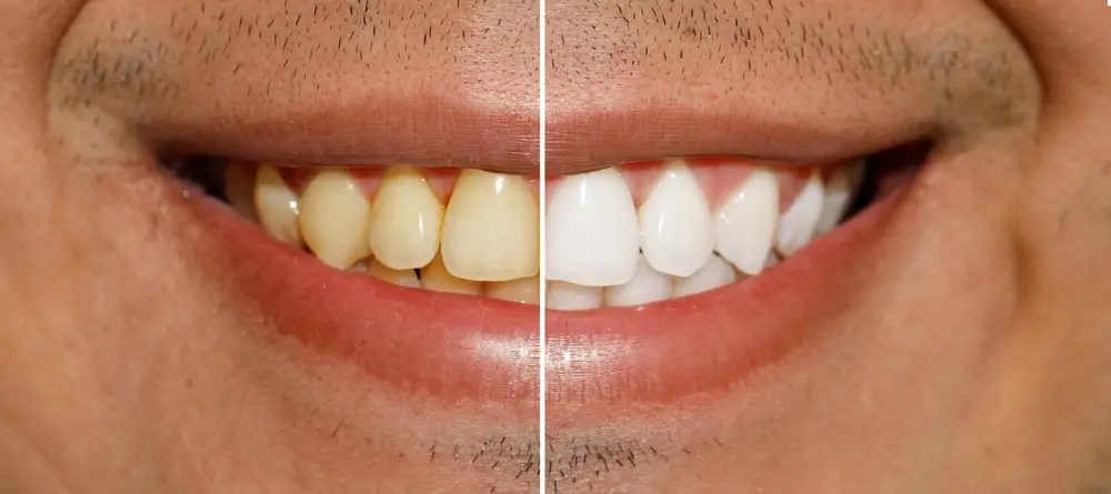 teeth whitening