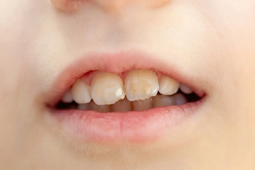 tooth erosion