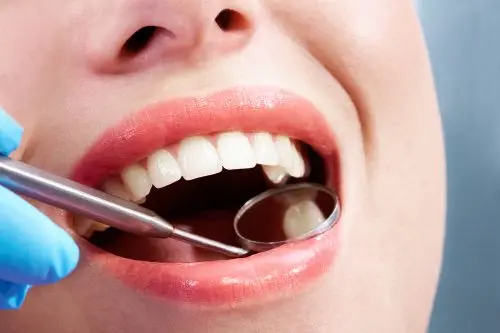 woman's mouth during dental checkup